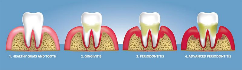 Understanding Gum Disease